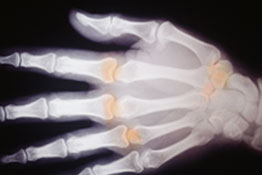 Xray of hand