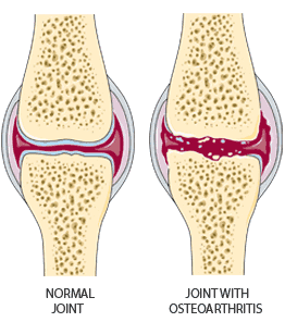 Diagram of healthy knee joint and joint with Osteoarthritis